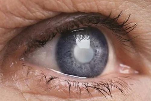 Jangan Sepelekan ! Inilah Tanda dan Gejala Awal Katarak yang Perlu Diwaspadai !