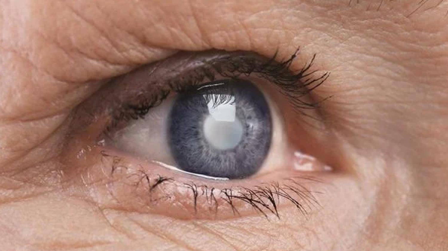 Jangan Sepelekan ! Inilah Tanda dan Gejala Awal Katarak yang Perlu Diwaspadai !