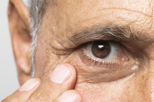 Glaukoma : Ancaman Tersembunyi bagi Penglihatan dan Cara Mencegahnya