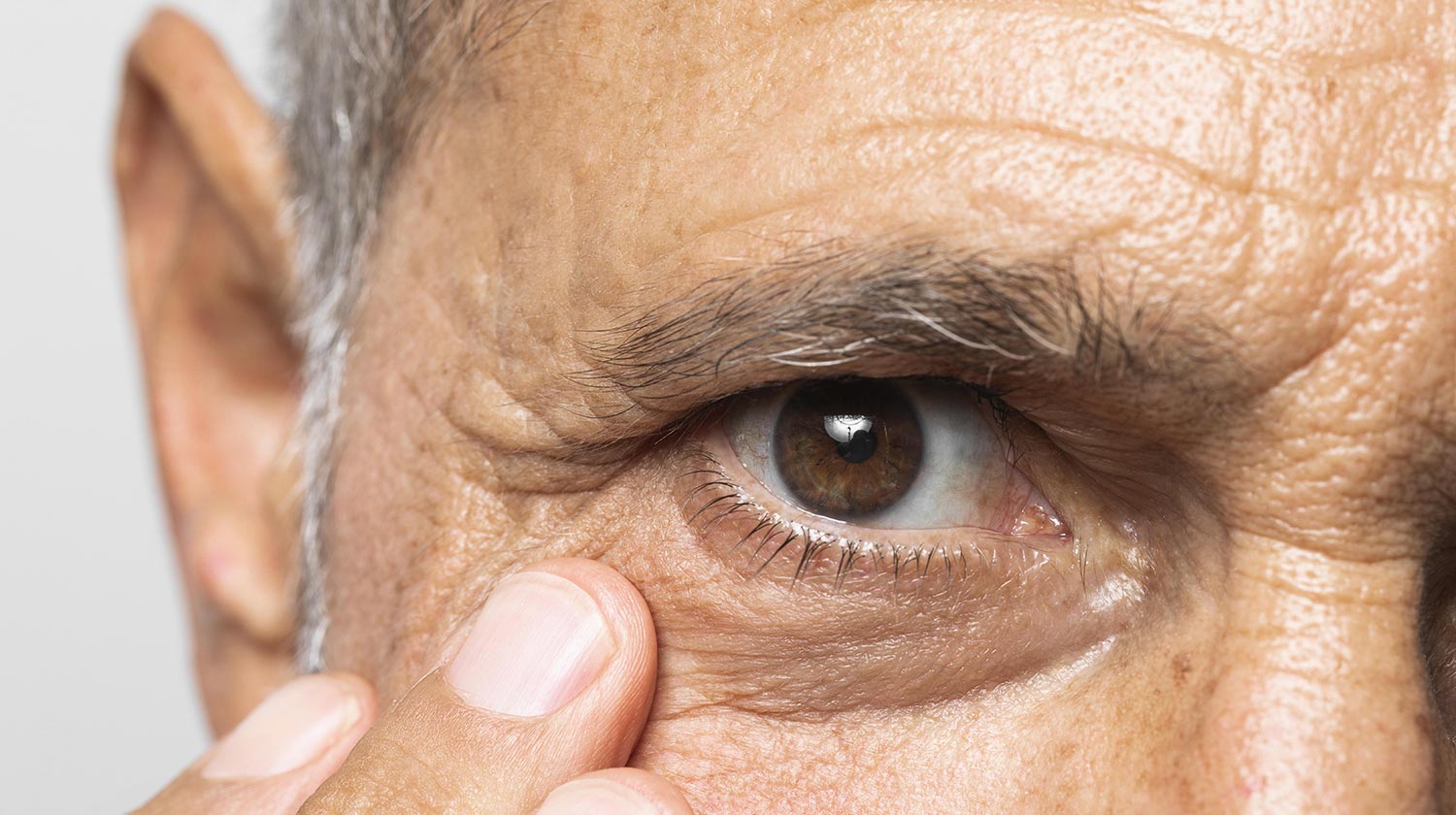 Glaukoma : Ancaman Tersembunyi bagi Penglihatan dan Cara Mencegahnya