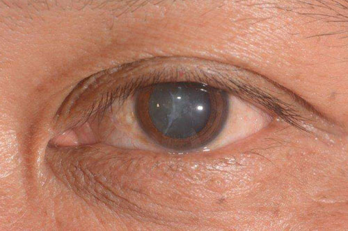 Mengenal Katarak : Penyebab Lensa Mata Keruh dan Pencegahannya !