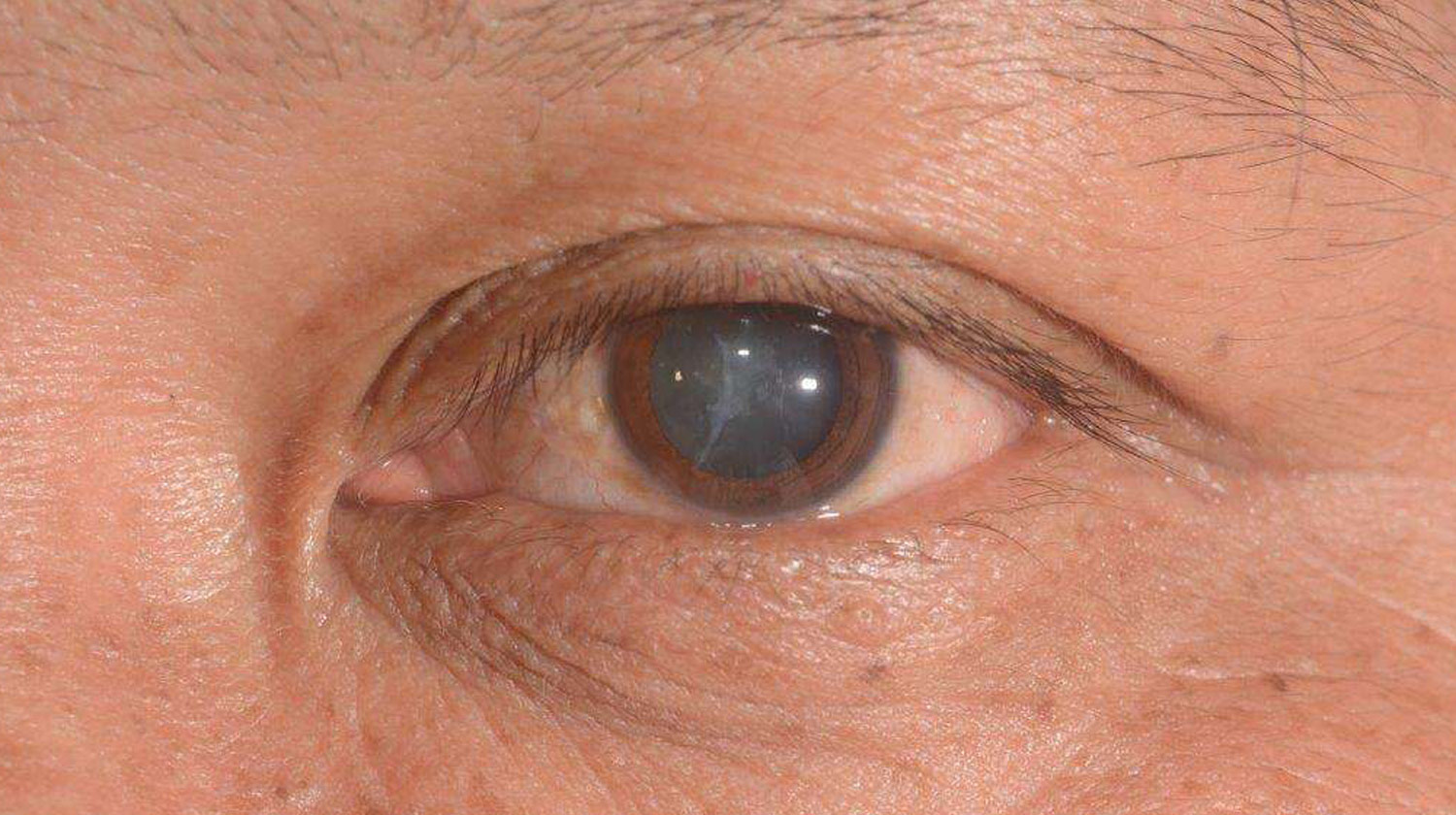 Mengenal Katarak : Penyebab Lensa Mata Keruh dan Pencegahannya !