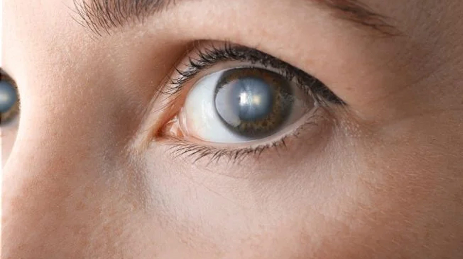 Katarak : Penyebab, Gejala dan Penanganan Efektif !