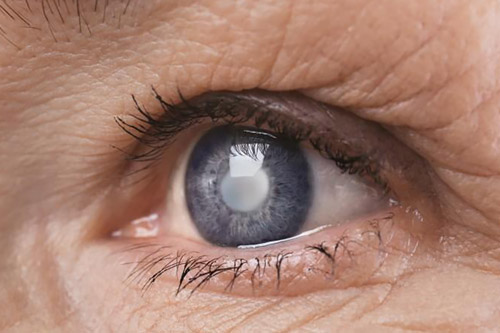 Siap Ucapkan Selamat Tinggal pada Pandangan Buram? Ini Tahapan Penting Operasi Katarak yang Perlu Anda Ketahui!