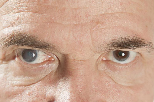 Gejala Katarak: Kenali Ciri-cirinya untuk Deteksi Dini & Penglihatan Jernih Optimal!