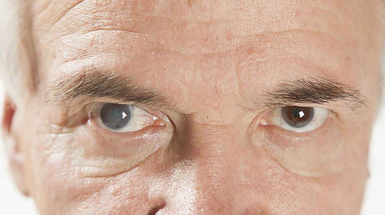 Gejala Katarak: Kenali Ciri-cirinya untuk Deteksi Dini & Penglihatan Jernih Optimal!