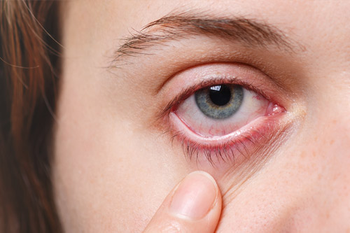 Glaukoma: Si Pencuri Penglihatan Senyap – Kenali Gejala, Penyebab, dan Pengobatan Terkini di EyeQu LASIK & Eye Center