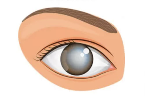 Mata Kabur Karena Katarak? Pahami Gejala, Penyebab, dan Solusi Pengobatannya!