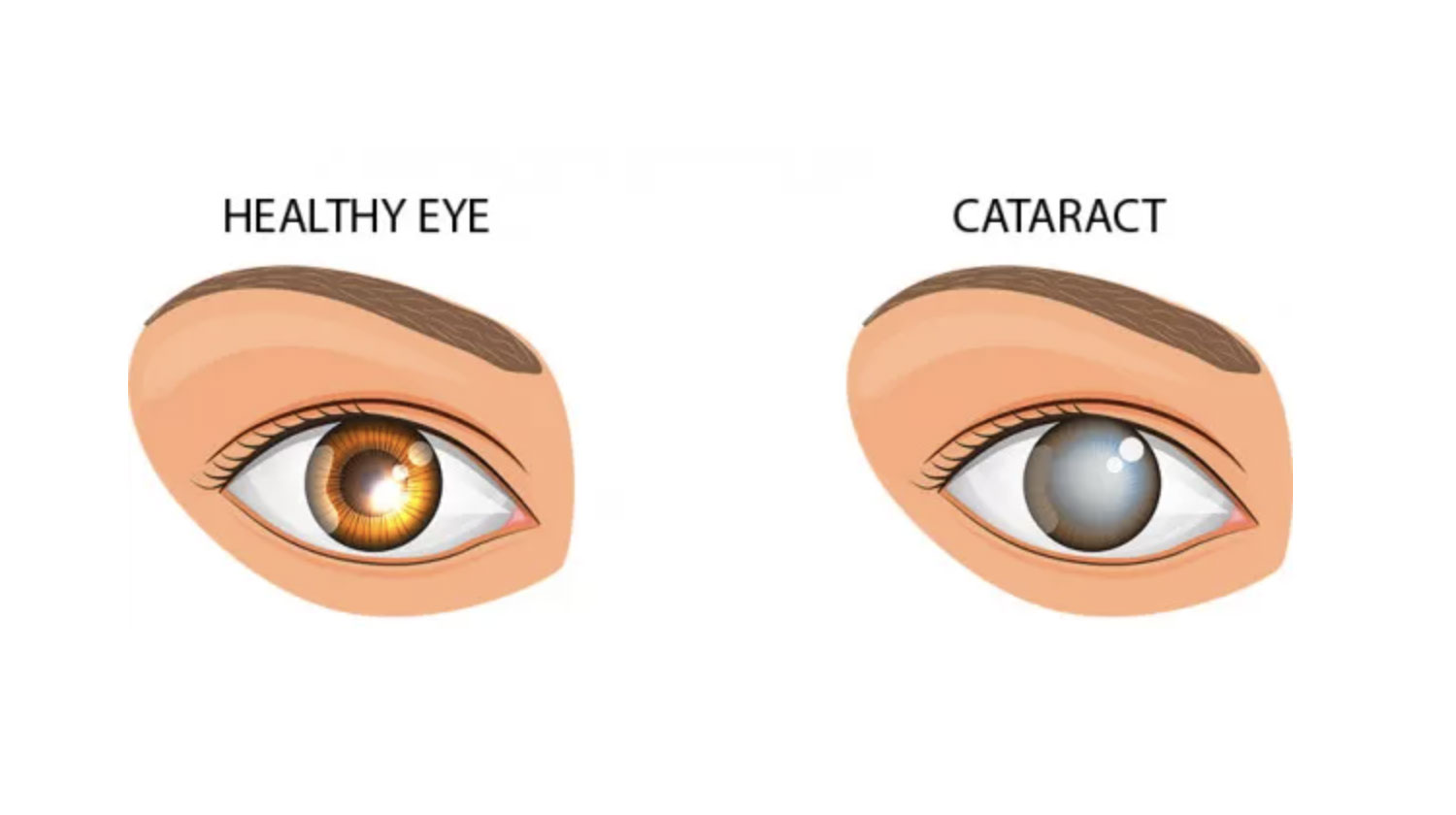 Mata Kabur Karena Katarak? Pahami Gejala, Penyebab, dan Solusi Pengobatannya!