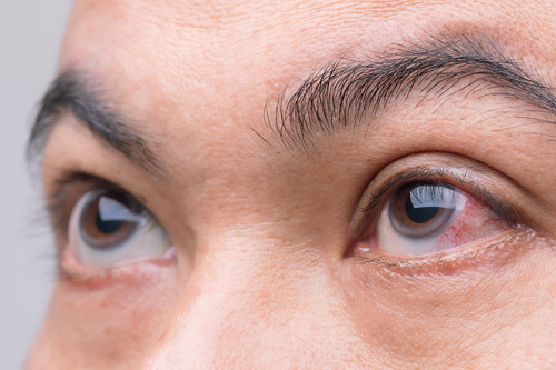 Mata Merah, Gatal, dan Perih? Jangan Sepelekan Iritasi Mata, Begini Cara Tepat Mengatasinya!