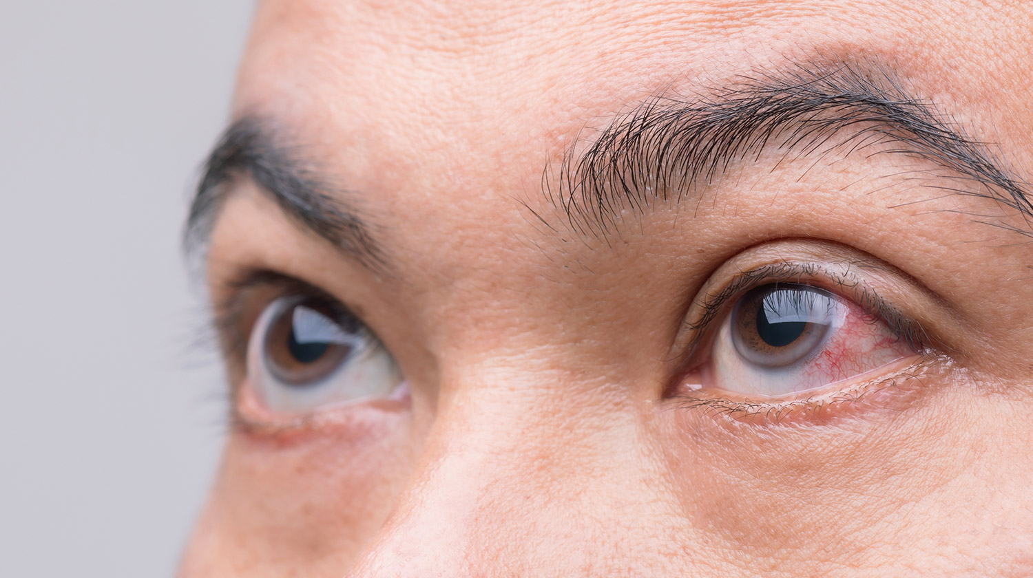 Mata Merah, Gatal, dan Perih? Jangan Sepelekan Iritasi Mata, Begini Cara Tepat Mengatasinya!