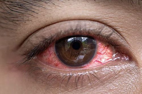 Jangan Anggap Sepele, Kenali Gejala Mata Merah dan Langkah Penanganan yang Efektif