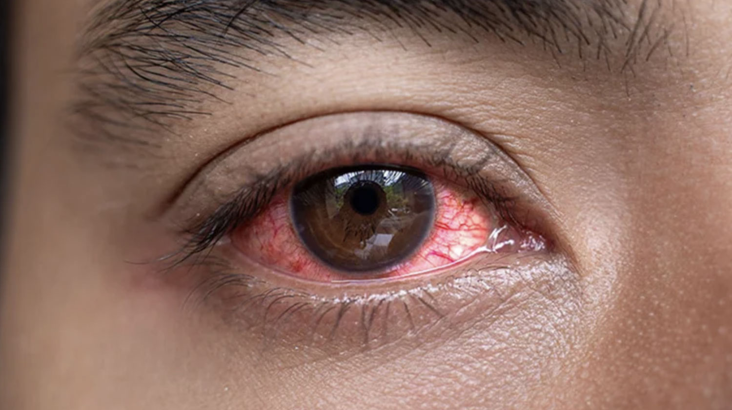 Jangan Anggap Sepele, Kenali Gejala Mata Merah dan Langkah Penanganan yang Efektif