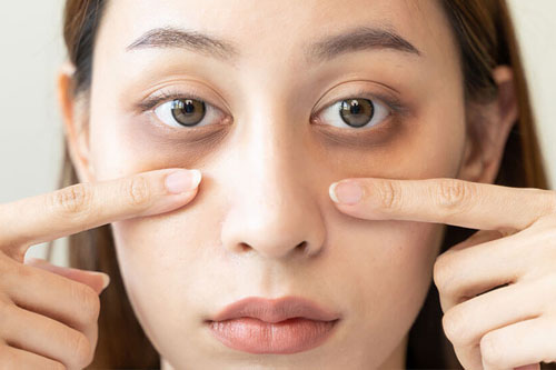 Cara Efektif Mengatasi Mata Panda: Pahami Penyebab dan Solusi Terbaik